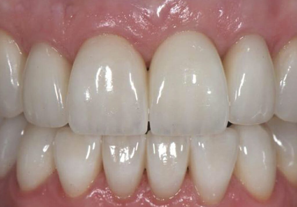 Dental Implants Video Dental Implants London